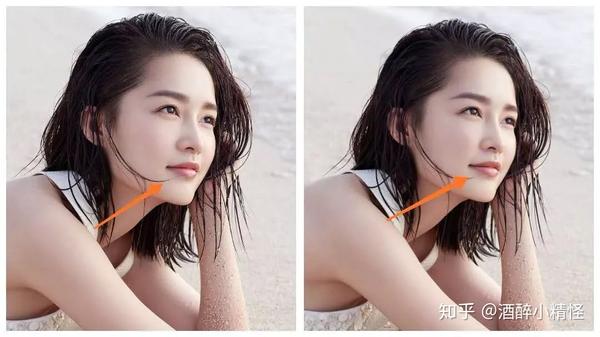 始于颜值,却陷于鼻子|鼻基底凹陷会带来哪些颜值bug?