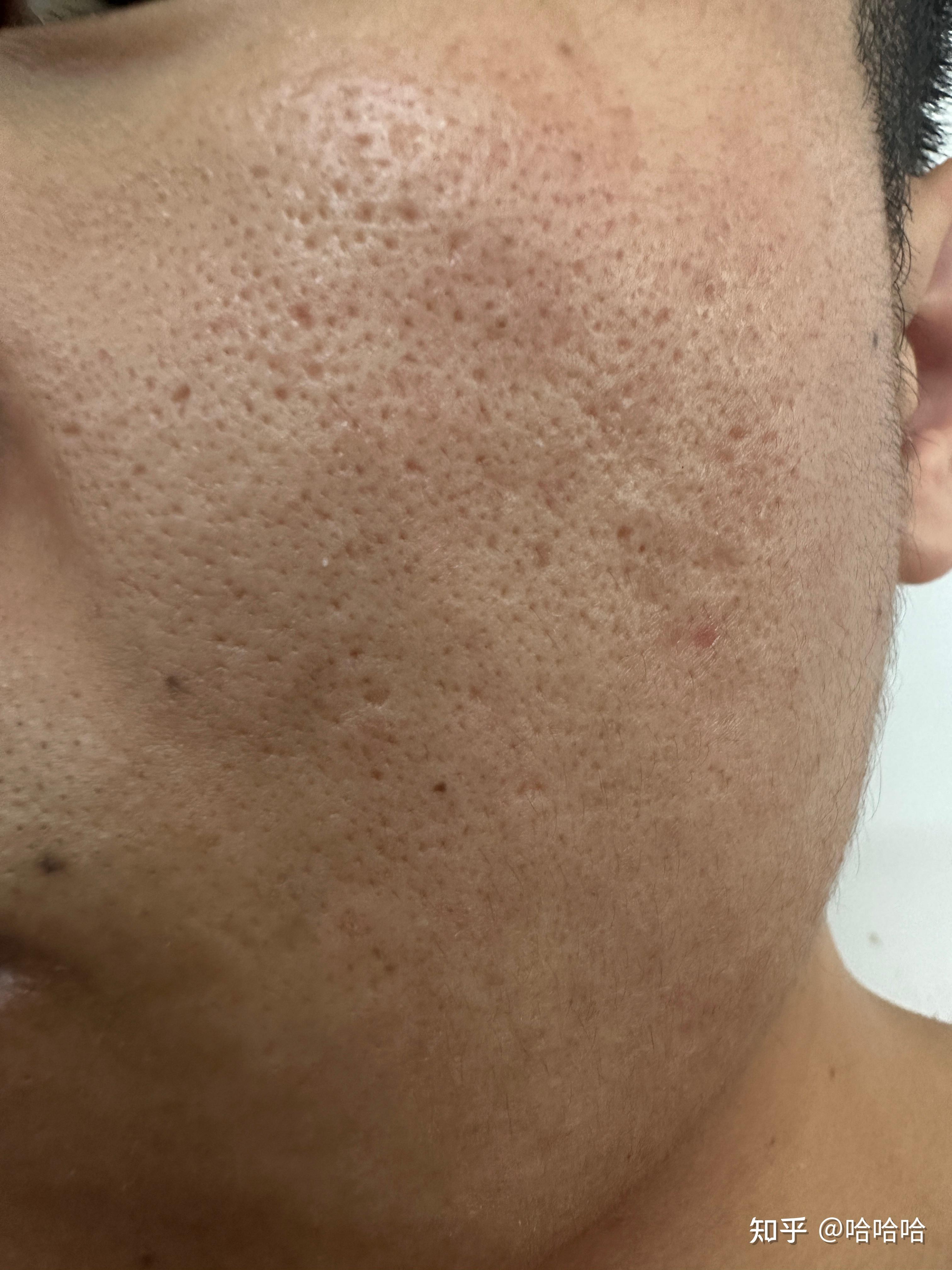 毛孔粗大还是痘坑