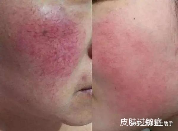 春季易发皮肤病及其预防 知乎