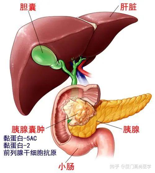 胰头癌图片位置示意图图片