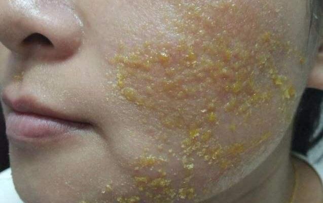 激素脸流黄水是什么原因?结痂又丑又难受跟毁容没区别