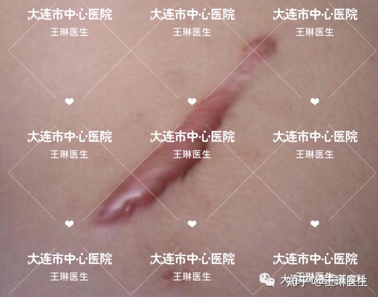 瘢痕和langers线多学科联合对抗瘢痕的全国对话