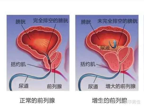 前列腺对比图什么原因导致前列腺肥大性生活不规律夫妻之间性生活过于