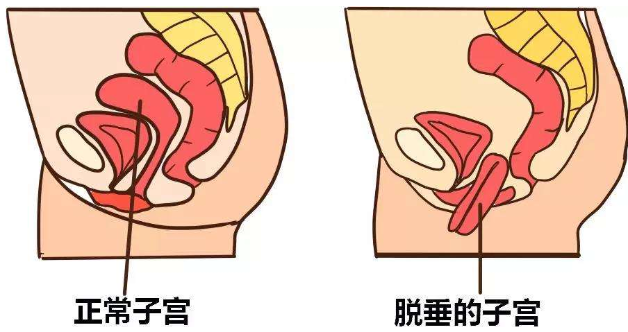 產後到底要不要做盆底肌修復看看網友們怎麼說