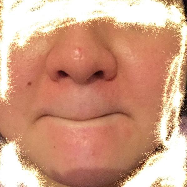 黑头粉刺巨恐怖怎么办?