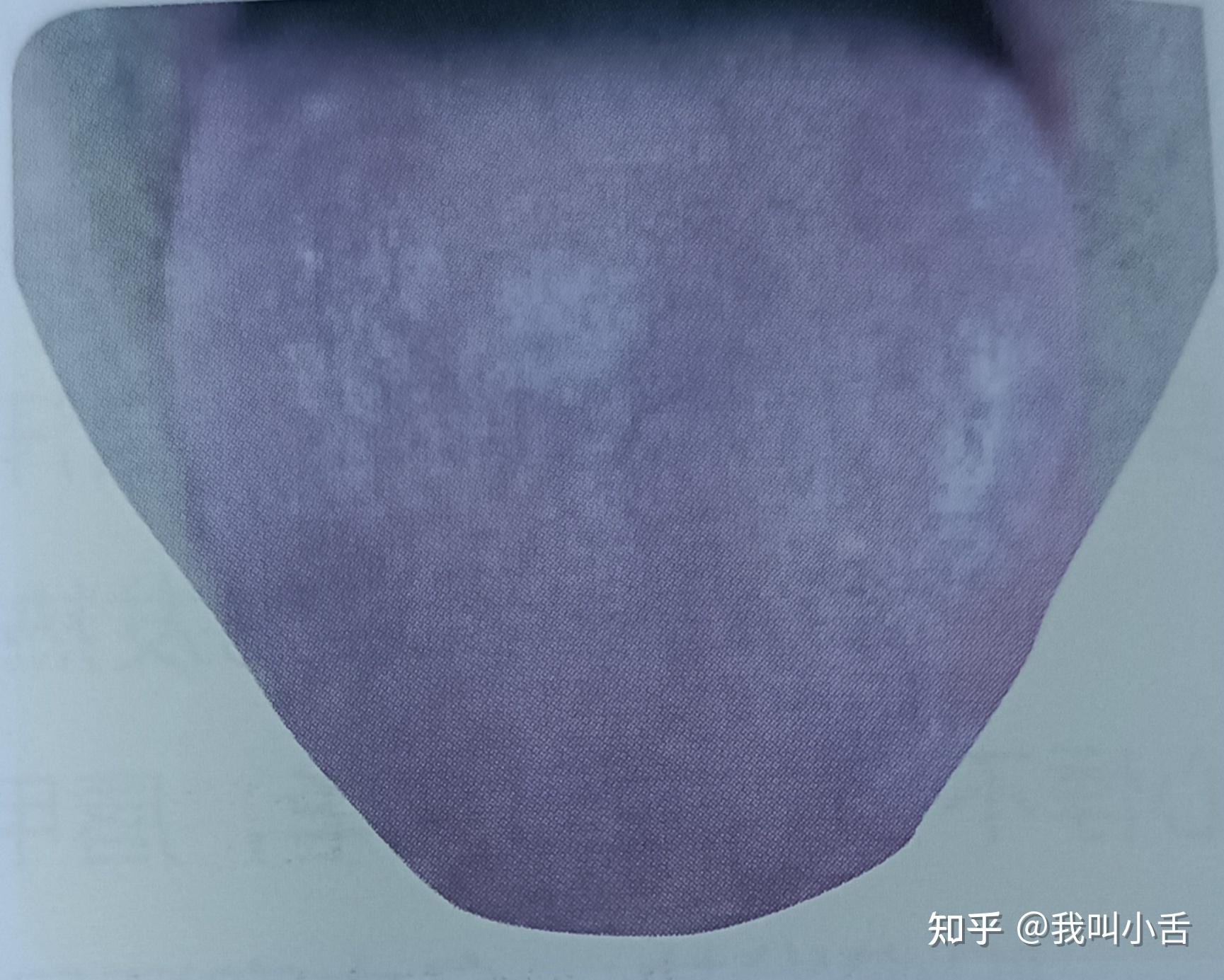 舌头的前世今生——望舌质——望舌色(绛舌) - 知乎