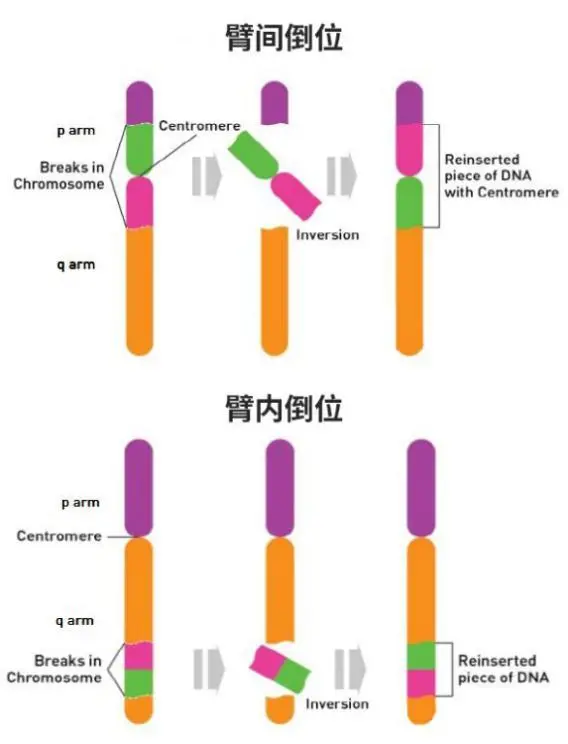 亿康基因助力珠海妇幼首次成功阻断染色体倒位向子代传递,珠海市首例