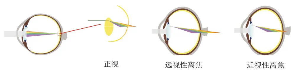 【光线综述】光强和波长对近视的影响 - 知乎