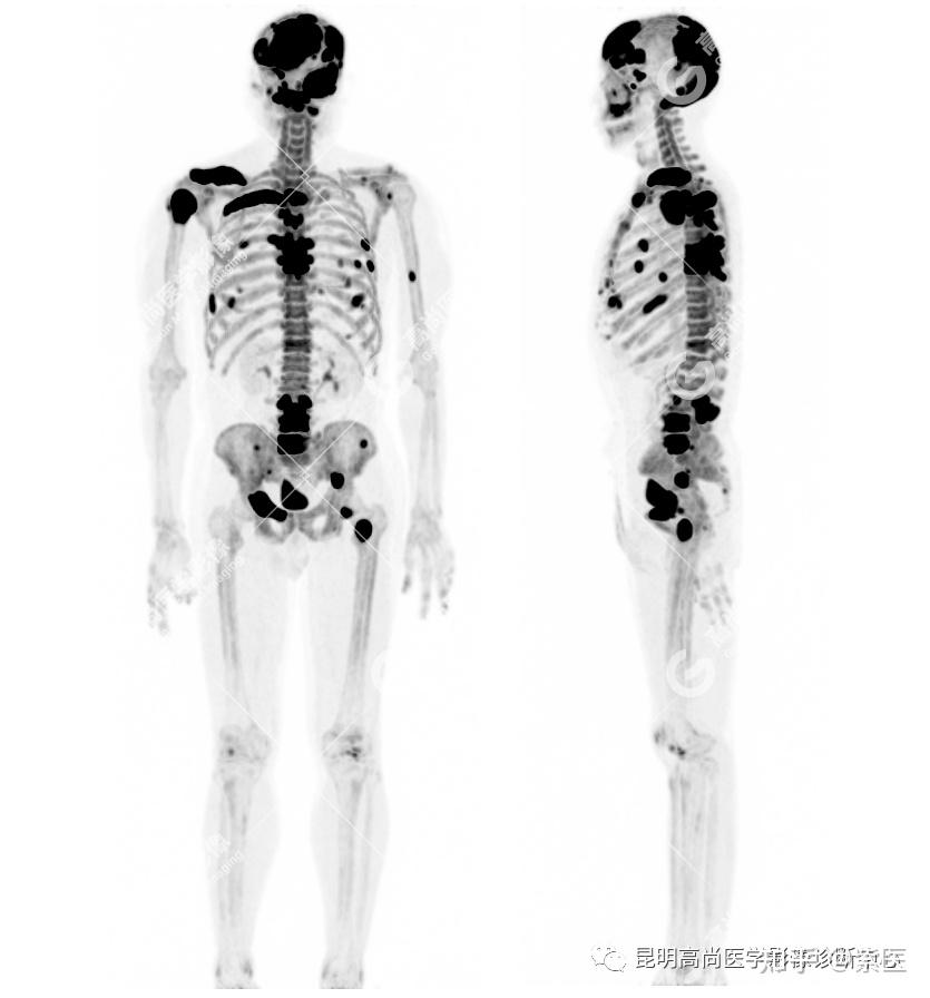 全身骨显像