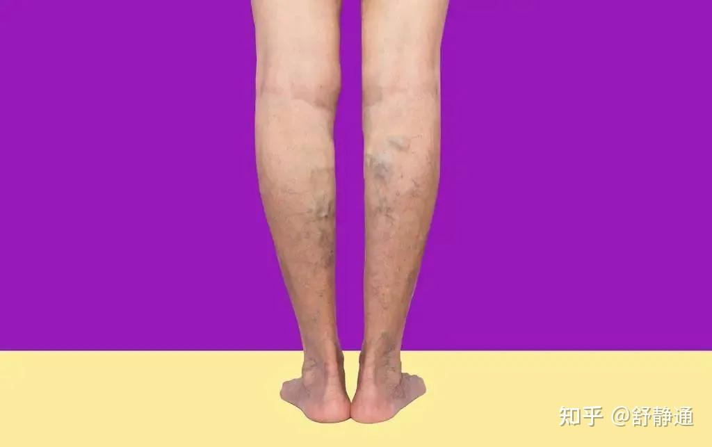 大腿上有紫色血管图片