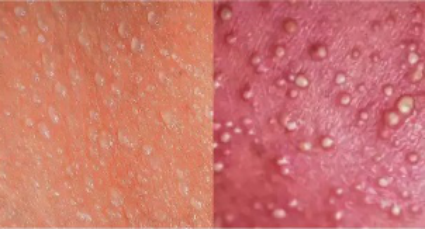 湿疹和痱子你还在傻傻分不清楚吗