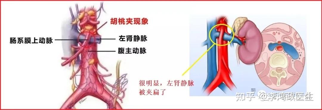 如上图,左肾静脉被两条动脉夹住了,正常人的左肾静脉也是从这个夹角穿