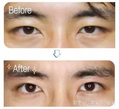 真实日记 年轻5岁的提眉术体验 眉下切 知乎