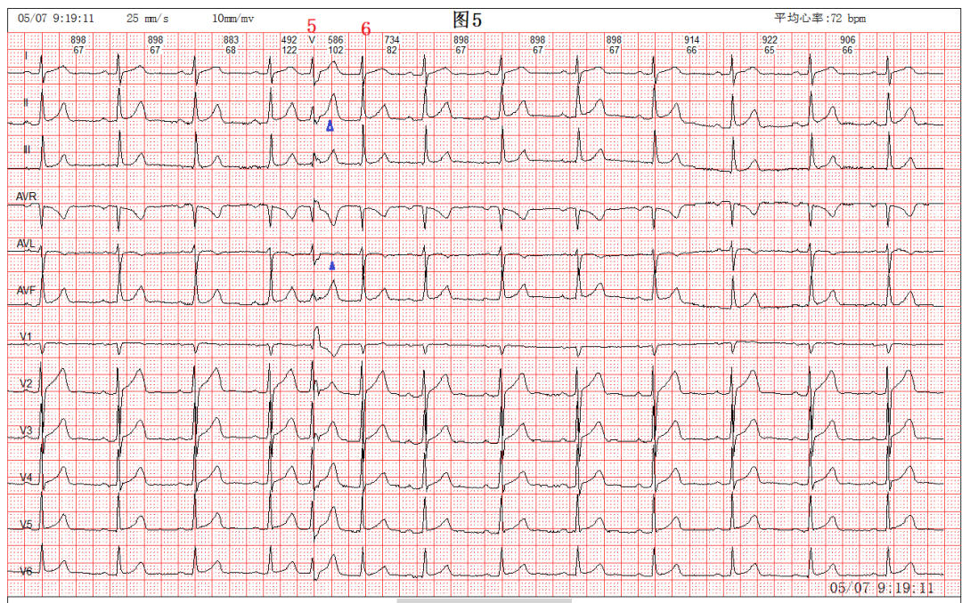 心电图pr间期图片图片