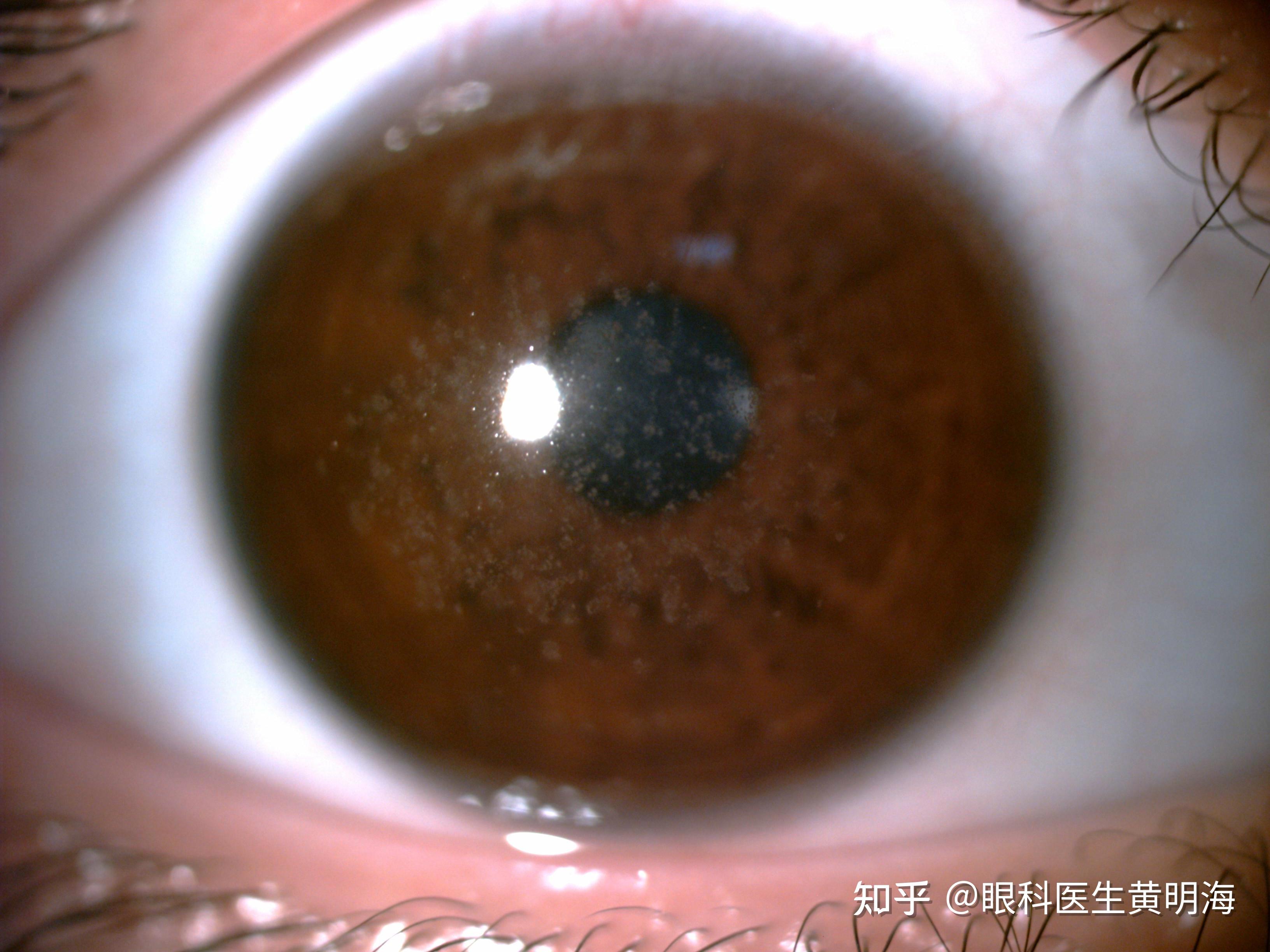 眼睛看不清,竟然是"营养不良" - 知乎