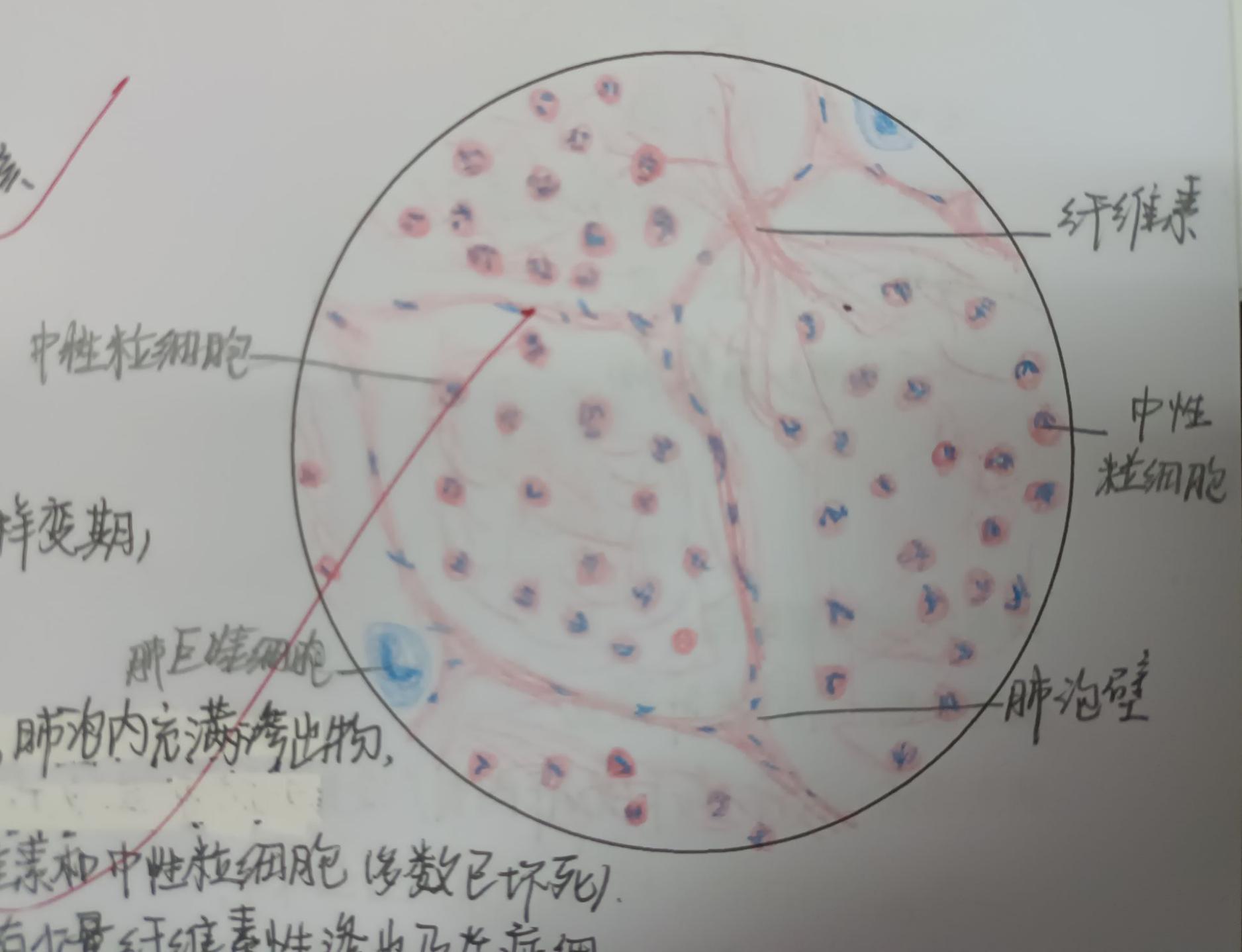 大叶性肺炎红肝期绘图图片