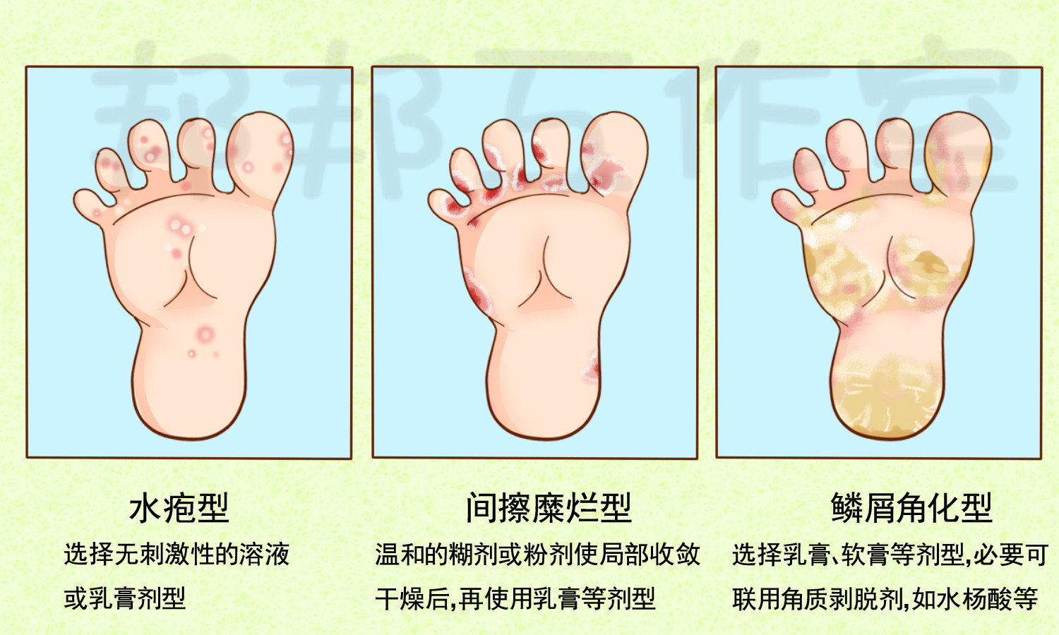 脚气治疗方法图片