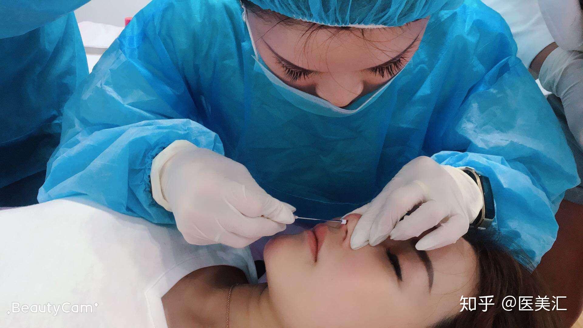 做完大v线雕之后多久才能再做听听医生怎么说