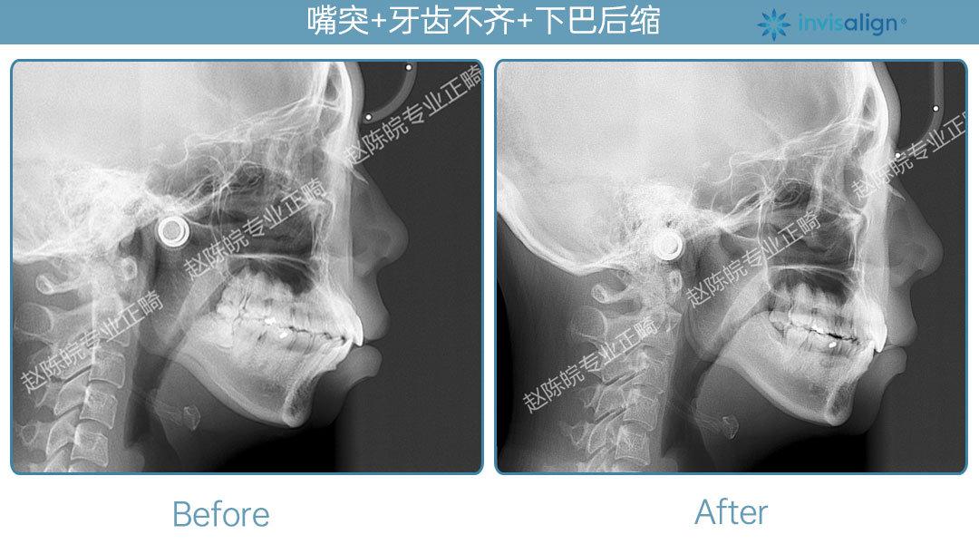 杭州赵陈皖入选隐适美全球案例库病例突嘴下巴后缩