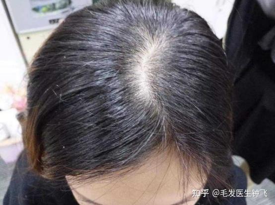 女性头顶稀疏，发缝宽是什么原因，要怎样改善? - 知乎