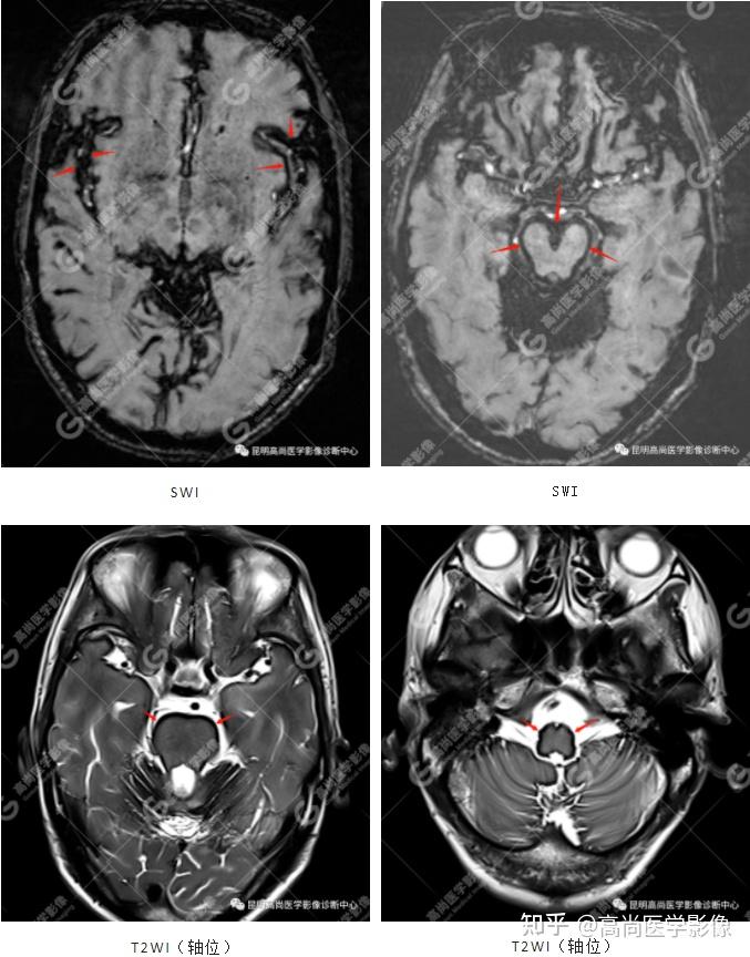 言语困难,表述不清,确诊:中枢神经系统表面铁质沉积症,伴轻度小脑萎缩
