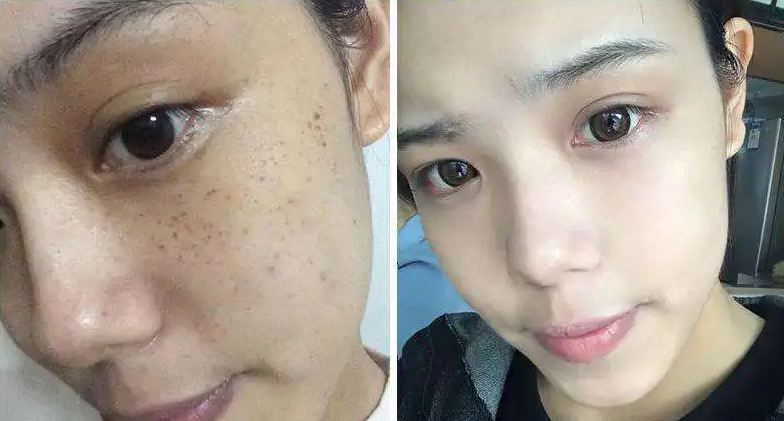 什么牌子祛斑霜效果好还不反弹的盘点十强祛斑名单