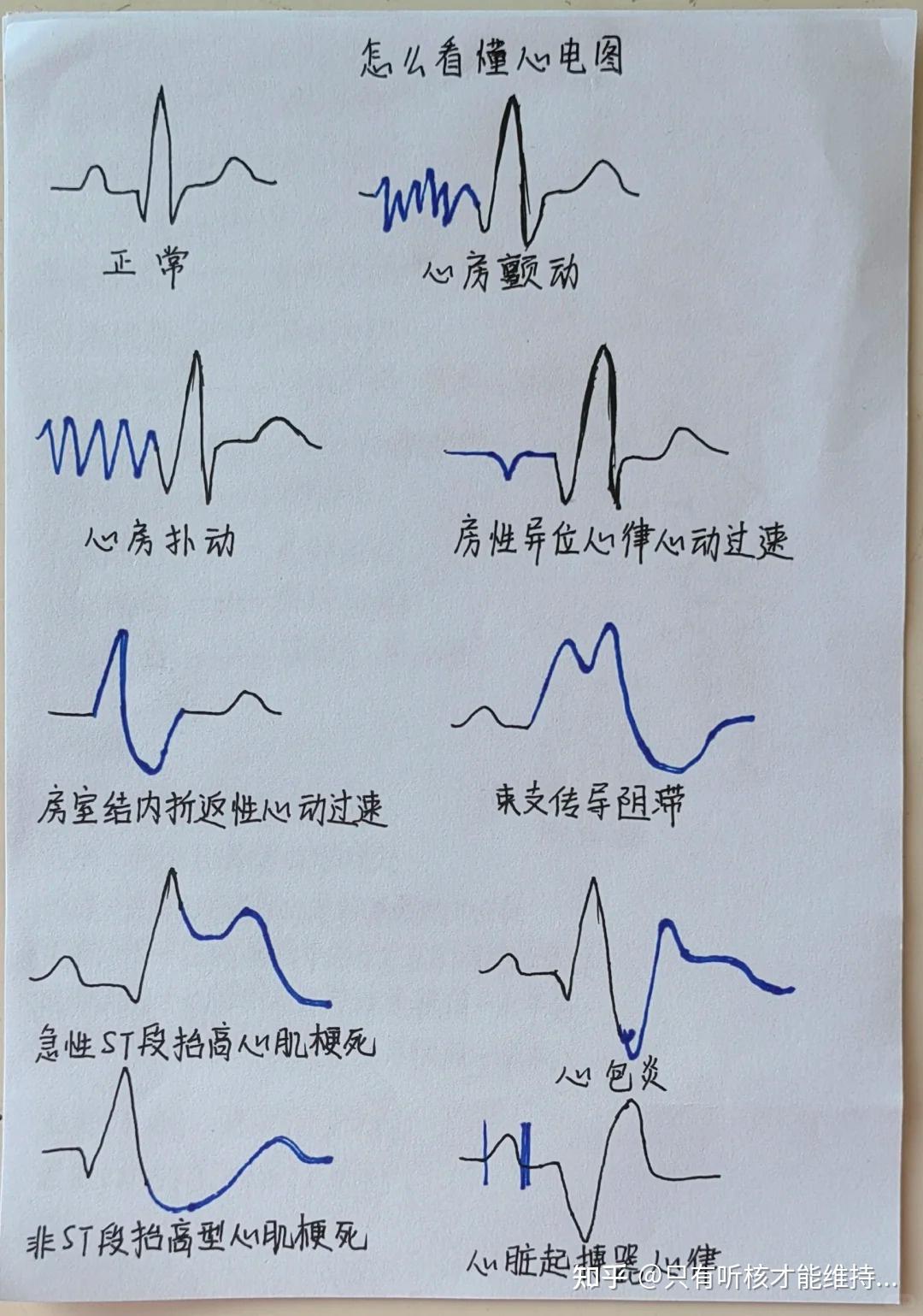 # #心电图[话题]#:q波增宽 st段弓背向上抬高,注意