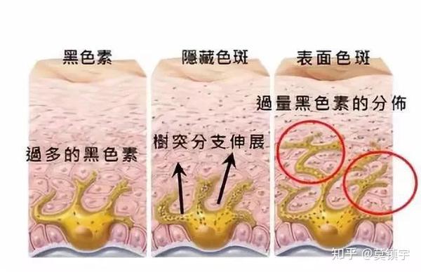 为什么女人比男人更容易长斑