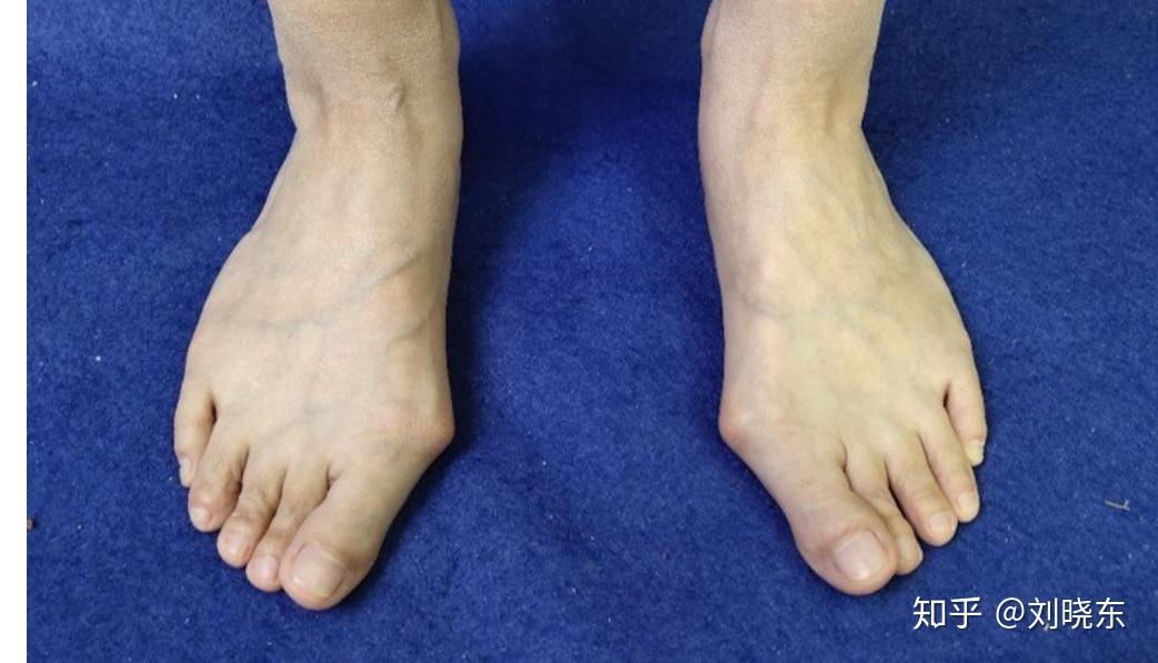 拇外翻 - 知乎