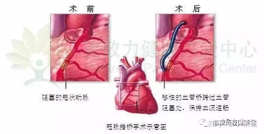 心脏搭桥手术过程图片图片