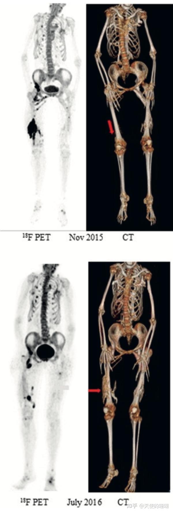 [18F]氟化钠(NaF) PET/CT扫描用于FOP异位骨化的早期标记物 - 知乎