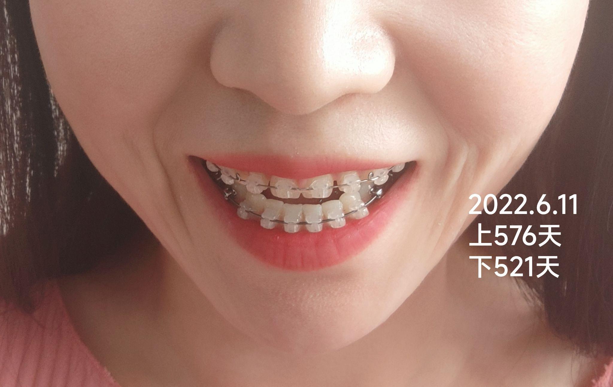 大龄正畸修复陶瓷自锁托槽牙缝和过小牙蜕变历程