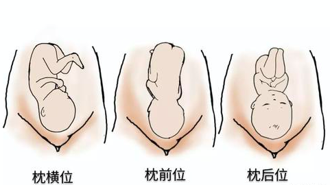 胎儿右枕横位图片图片