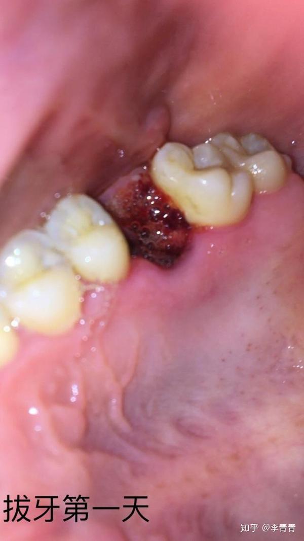 拔牙7天后牙窝状态图图片