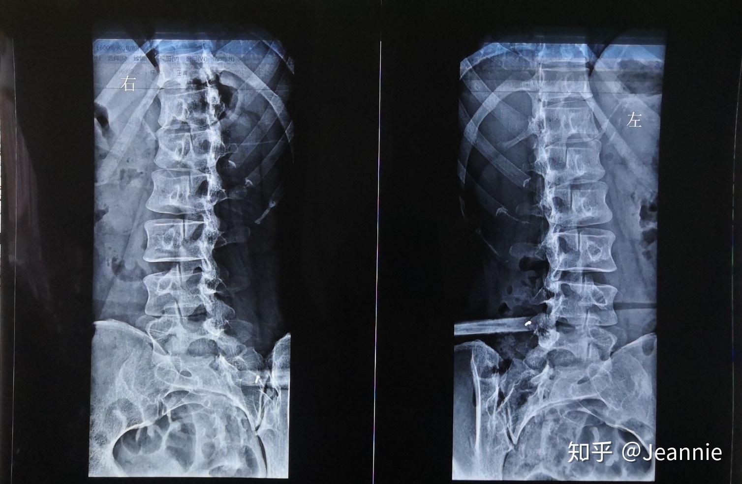 腰椎间盘突出怎么办