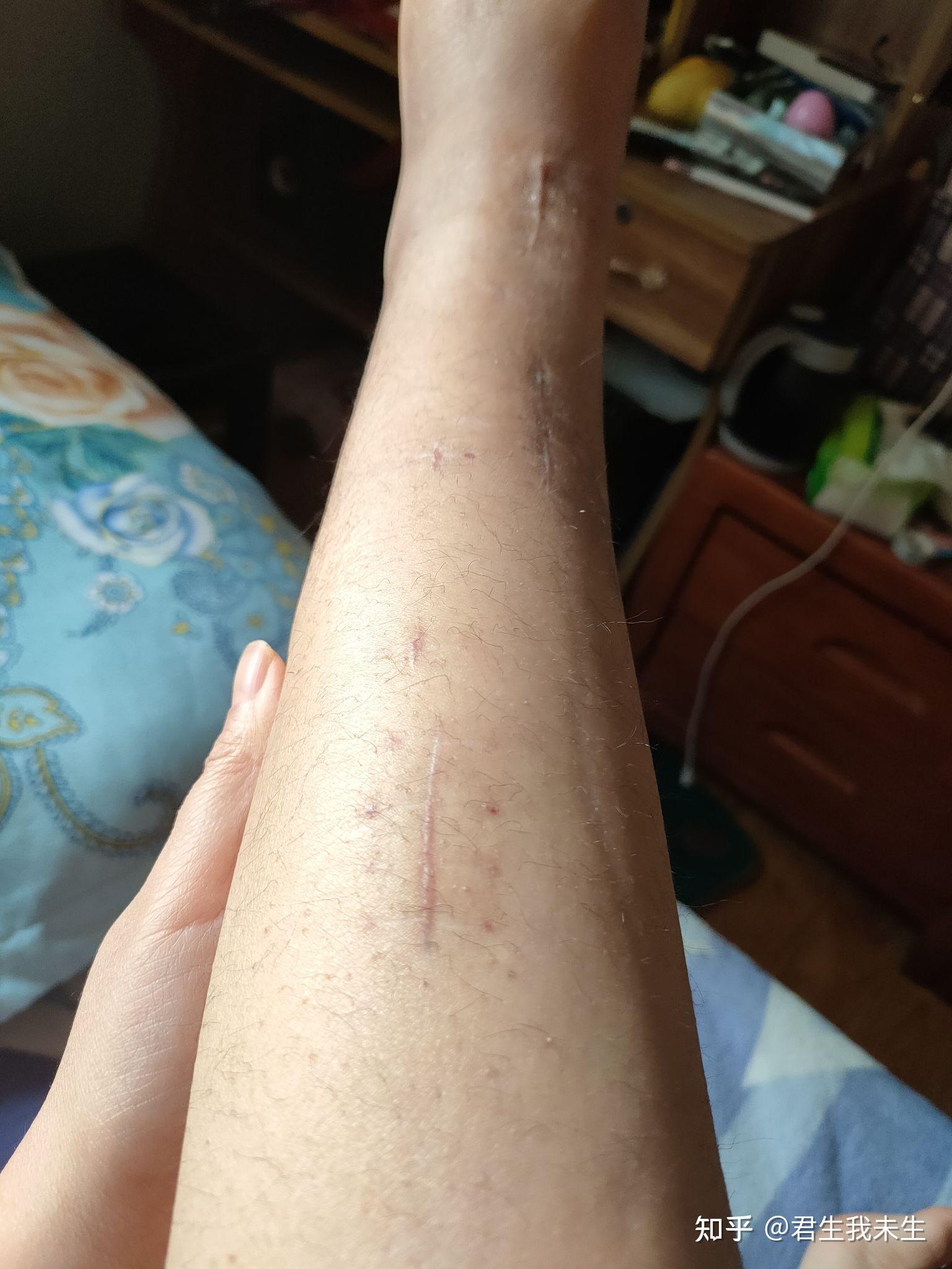 胫腓骨粉碎性骨折后如何康复持续更新