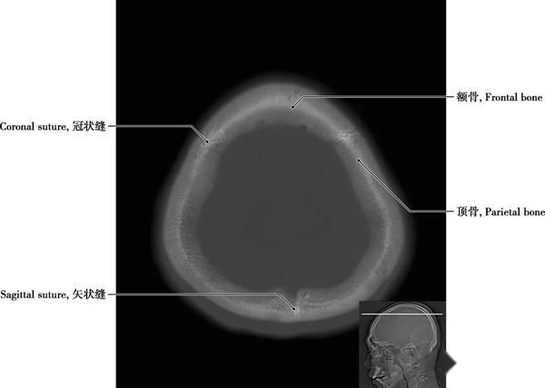 详细标注版!颅脑CT正常解剖图谱 - 知乎