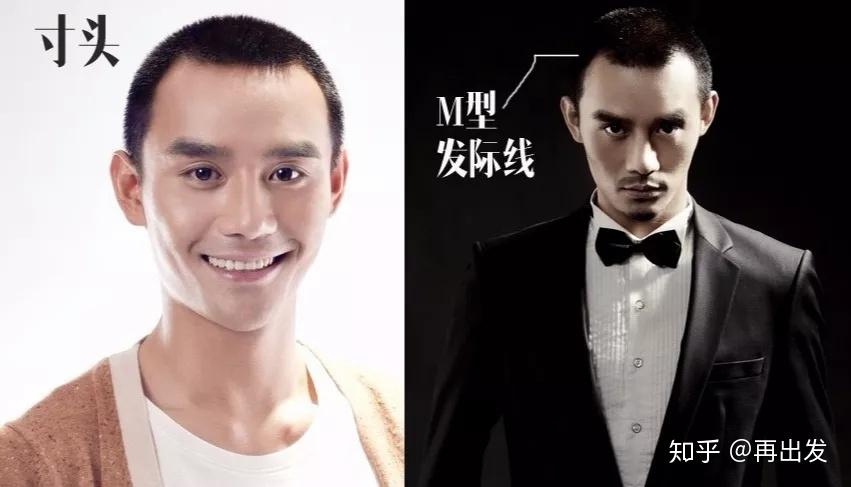 发际线后移不仅是显老背后暗藏脱发才可怕