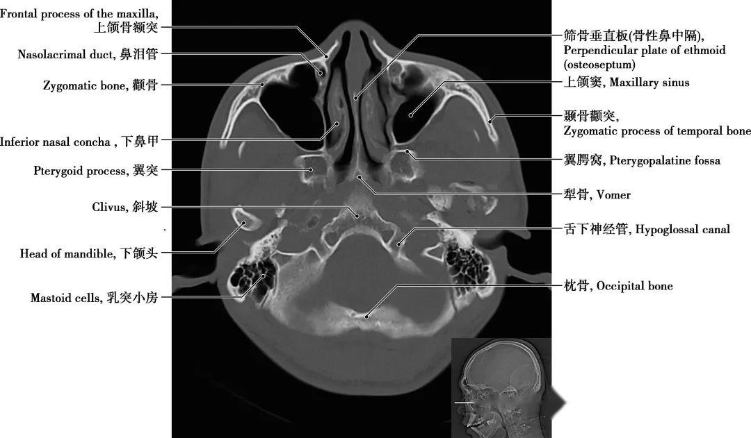 颅骨解剖图ct图片