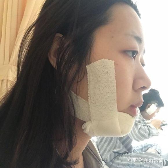 北京颏成型手术细节分享没有对比就没有伤害