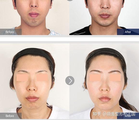 凸嘴矫正手术正颌手术的一些后遗症科普