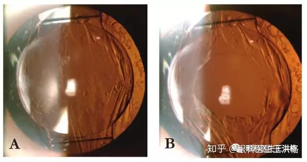 譬如原先有糖尿病的病人可能出现糖尿病性视网膜病变,玻璃体积血