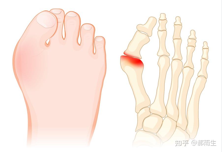 郝雨生，轻度拇外翻如何自己矫正? - 知乎