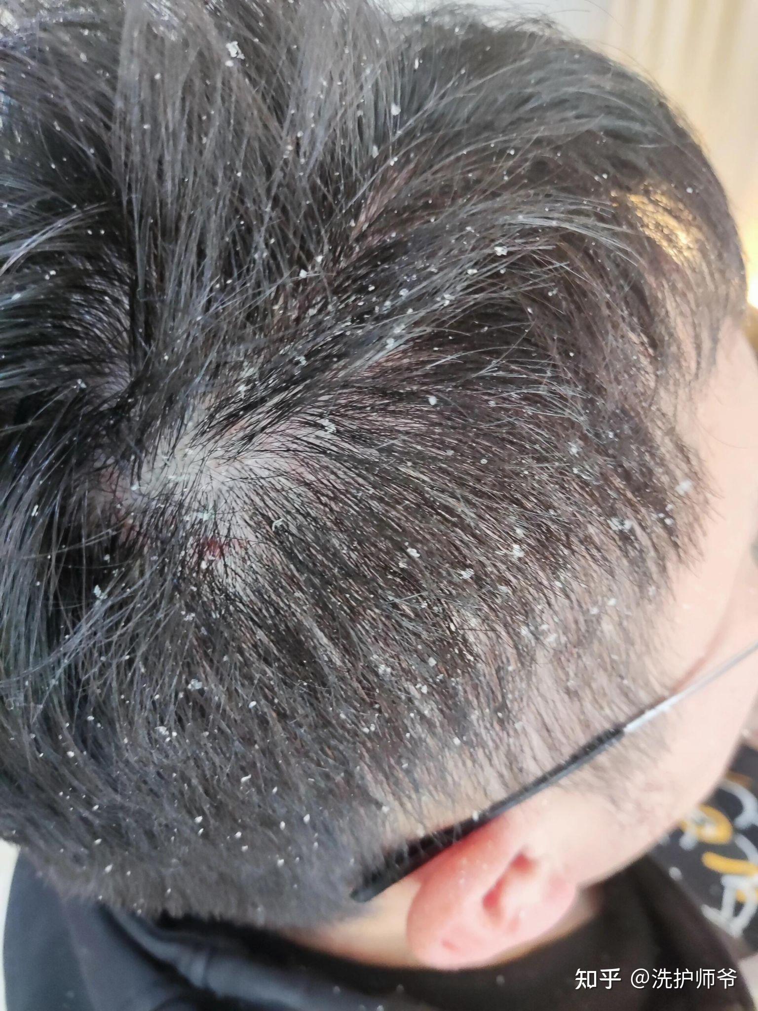 头皮屑多是什么原因怎么处理有什么好的方法妙招 - 知乎