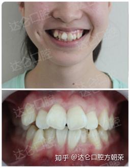 青少年高三群体需谨防颞下颌关节紊乱二