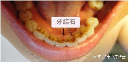 口臭结石在哪个位置图片