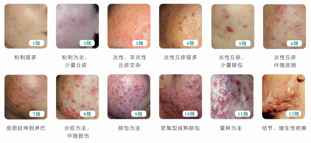 霍尊事件持续发酵,他的皮肤问题值得关注 - 知乎