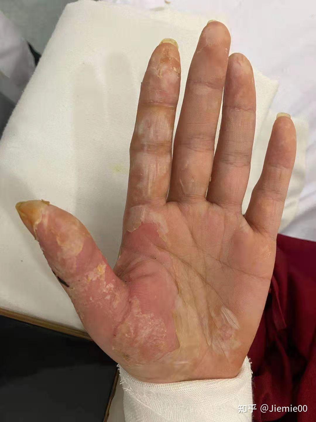 火锅烫伤深2度浅2度恢复后寻求抗瘢痕治疗方法