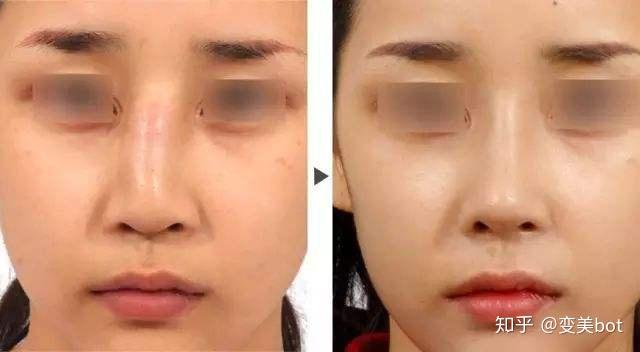 隆鼻硅胶假体的包膜挛缩问题并不是l型假体才会挛缩柳叶型依然会