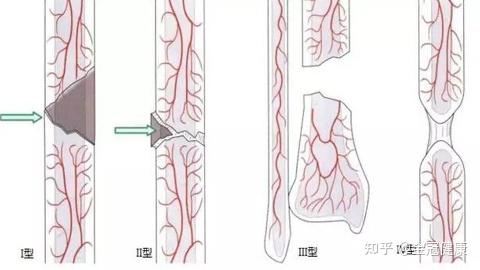 通常認為斷端的軟骨帽具有骨骺軟骨的特性,軟骨生成的速度和軟骨骨化